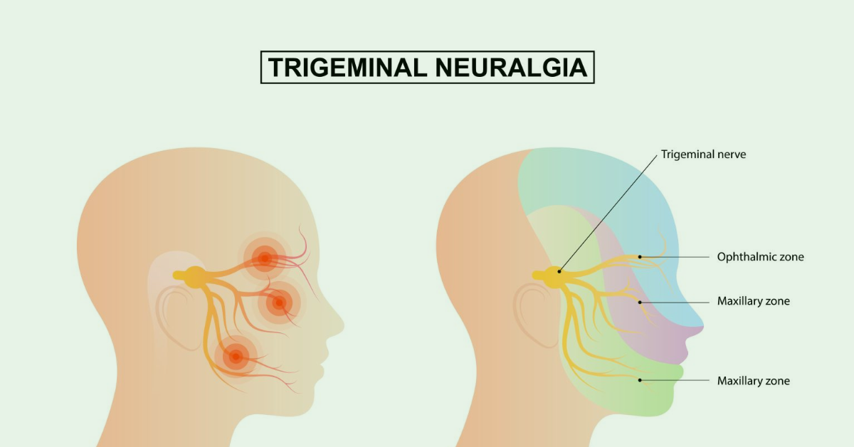 Exploring Effective Alternative Treatments for Trigeminal Neuralgia