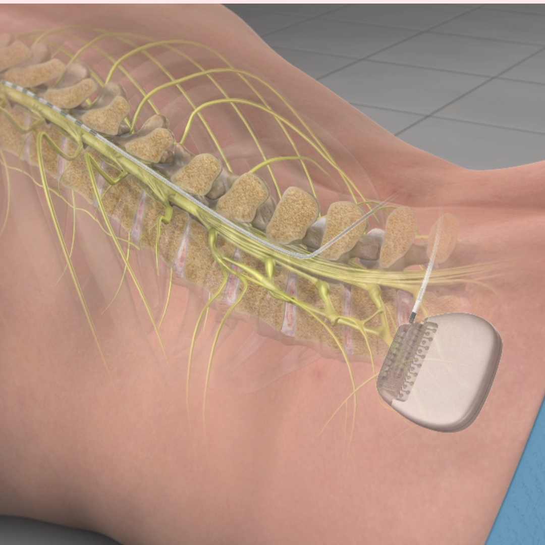 The Benefits of Spinal Cord Stimulation Therapy for Chronic Pain Relief
