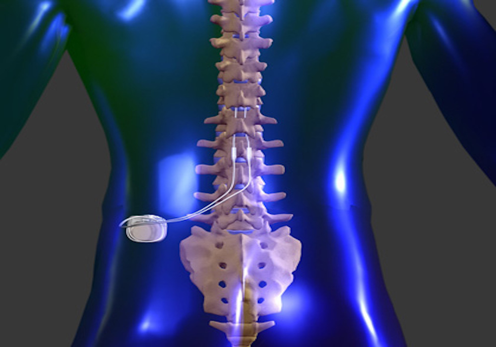 What to Expect from a Spinal Cord Stimulation Procedure: A Patient’s Guide